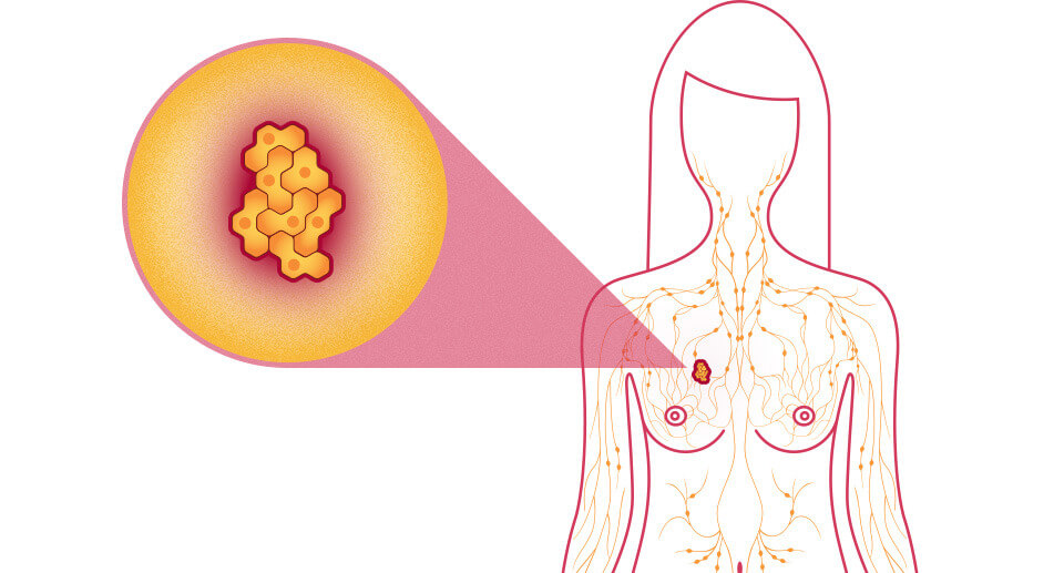 What Can You Do When It Comes To Breast Cancer